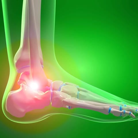 Arthrose im Fuß: Unter Arthrose versteht man eine primär verschleißbedingte Gelenkerkrankung, die prinzipiell alle Gelenke betreffen kann und verschiedene Ursachen hat