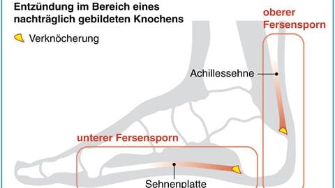 Infografik zum Fersensporn