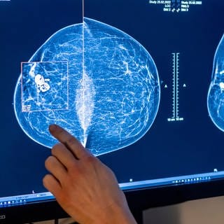 Medizinisches Personal untersucht mit einer Mammografie die Brust einer Frau auf Brustkrebs.