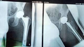 Eingesetzte Hüftprothese von Zimmer Biomet auf einem Röntgenbild