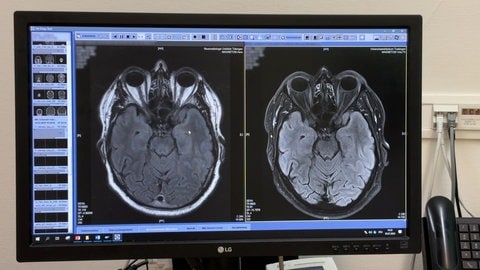 Bildschirm mit den Bildern des Gehirns eines Patienten aus dem MRT der Uniklinik Tübingen: Der bösartige Hirntumor ist nicht wiedergekommen nach der OP.