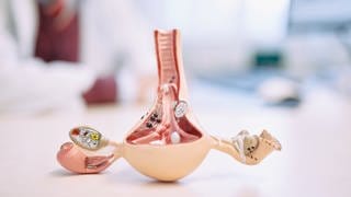 Ein Forschungsverbund der Uniklinik Tübingen erhält Millionen für die Forschung zu Endometriose. Rund zwei Millionen Frauen in Deutschland sind von der Erkrankung betroffen.