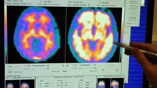 Gehirn von einem gesunden und einem Alzheimer-Patienten
