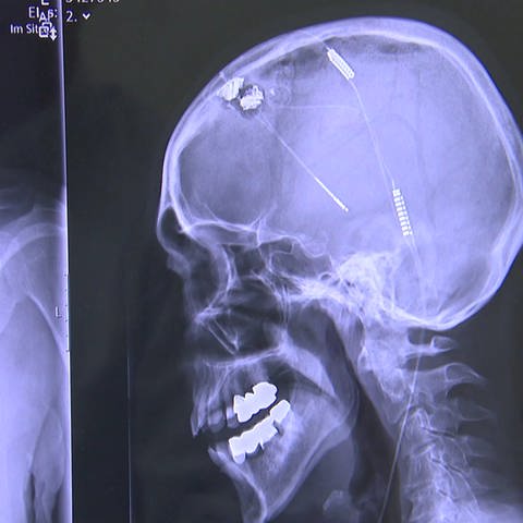 ein bildgebendes Verfahren zeigt die Position eines Hirnschrittmachers im Gehirn eines Patienten an