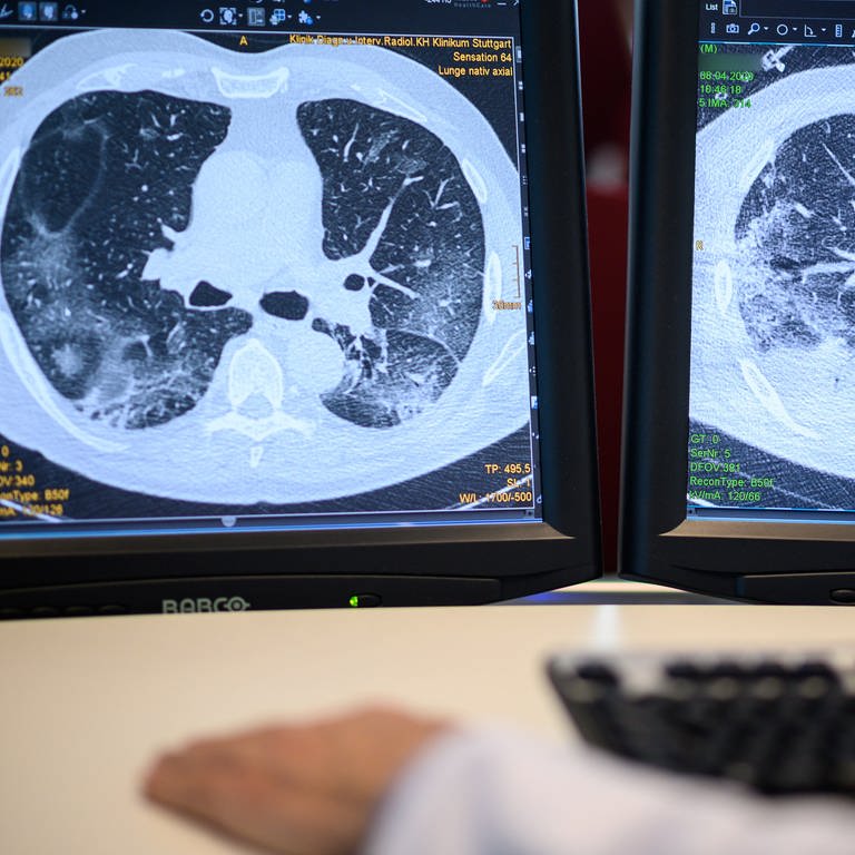 Röntgen-Aufnahme einer Long-Covid-Lunge