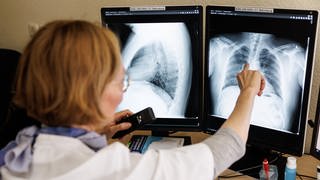 Symbolbild: Eine Radiologin analysiert in ihrem Büro in der Lungenklinik Gauting die Röntgenbilder der Lunge einer aus der Ukraine geflüchteten Person.