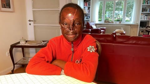 Bei einem Feuer hat sich die elfjährige Tracy schlimme Verbrennungen im Gesicht und an der Hand zugezogen. In der Diakonie in Bad Kreuznach wurde sie deswegen bereits mehrere Male operiert.