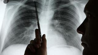 Lungenkrebsdiagnose