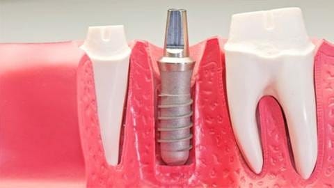Zahnmodell mit Implantaten