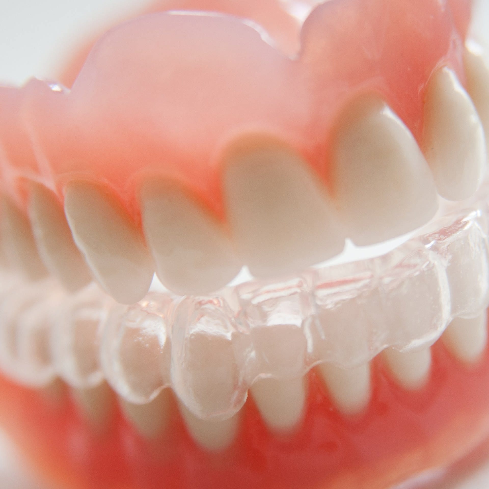 Zähneknirschen – Ursachen und Behandlung