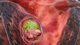 Embryo wird im Mutterleib mit Viren infiziert (Grafik): Bei einer Infektion mit dem Zytomegalie-Virus in der Schwangerschaft kann das Kind schwerwiegende Schäden davontragen. 