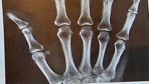 Fingerknochen auf einem Röntgenbild