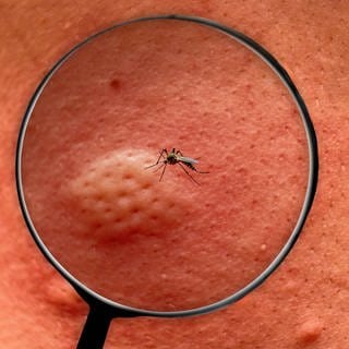 Blick einer Mücke durch ein Vergrößerungsglas auf die menschliche Haut während eines Stichs.