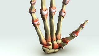 Knochen und Gelenke einer Hand mit rheumatischer Arthritis (Grafik): Die rheumatoide Arthritis ist die häufigste entzündliche Gelenkerkrankung