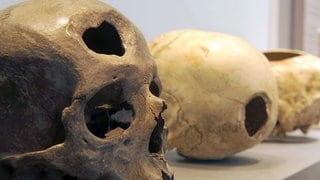 Durch medizinische Eingriffe aufgebohrte Schädel (Trepanation) 2009 in einer der Vitrinen zur Sonderausstellung "Ex Oriente Lux?" im Augusteum von Oldenburg