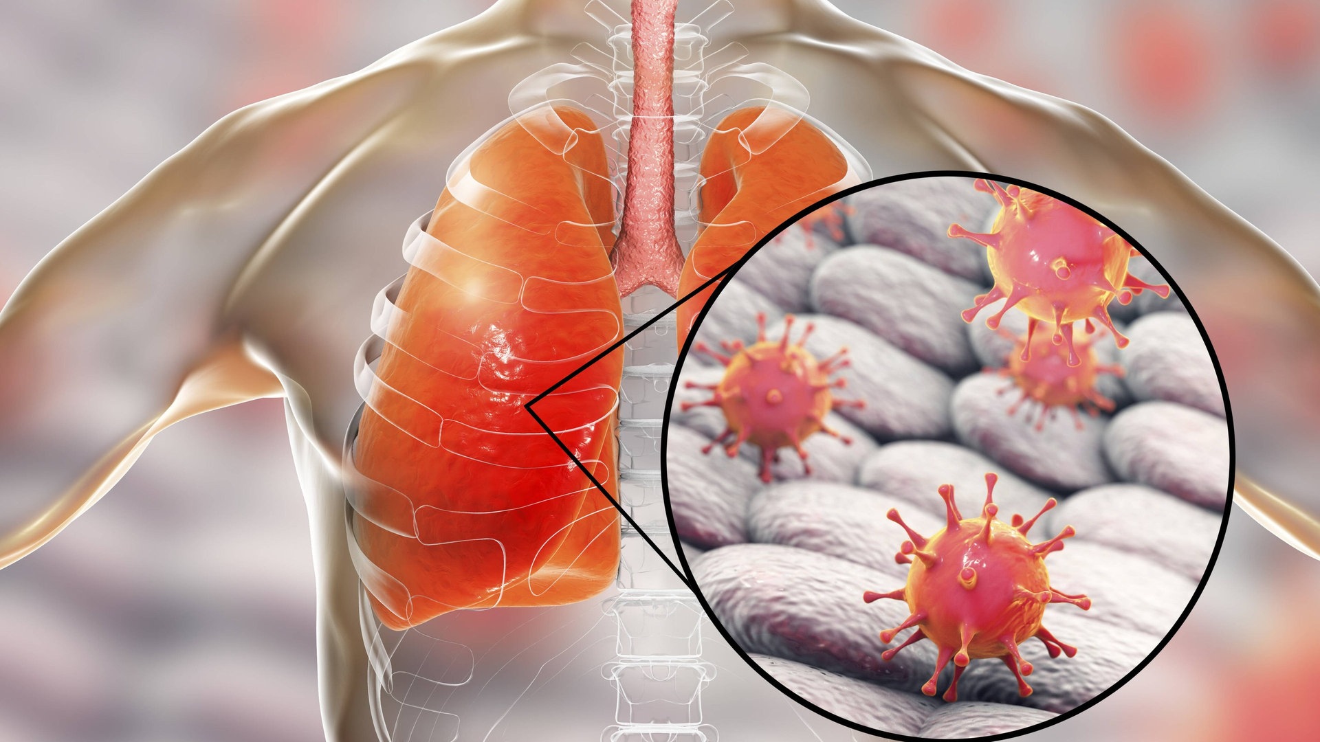 Symptome Coronavirus Ist Covid-19 Gefährlicher Als Die Grippe? - SWR Wissen