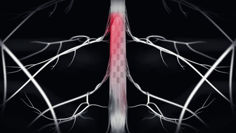 Das Bild zeigte eine Illustration der Studienautoren, wie die Prothese am Rückenmark sitzt. (Foto: EPFL/CHUV/UNIL, Inserm, CNRS; Université de Bordeaux)