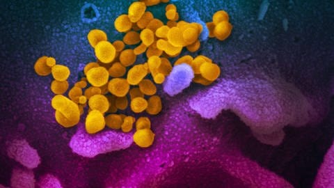 Dieses Rasterelektronenmikroskopbild zeigt das SARS-CoV-2-Virus (gelb) - isoliert von einem Patienten in den USA. 