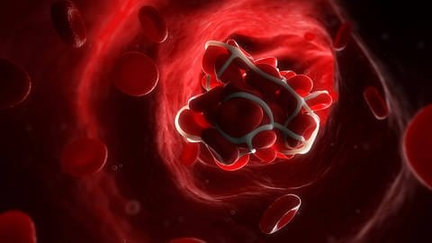 Derzeit wird erforscht, ob Blutverdünnner bei schweren Verläufen einer Covid-19 Erkrankung das Risiko von Thrombosen oder Lungenembolien verringern können.