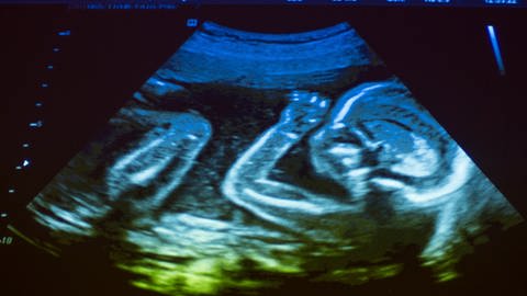 Ultraschallbild eines Embryos, der sich ans Gesicht fasst