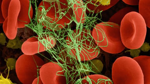 Rote Blutkörperchen in einem Fibrin-Blutgerinnsel gefangen.