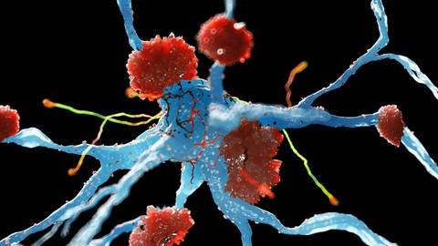 Von Alzheimer betroffene Nervenzellen