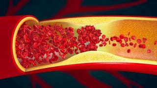 Ein erhöhter LDL-Cholesterinspiegel kann das Risiko von Herz-Kreislauf-Erkrankungen erhöhen.