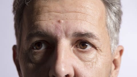 Glaukome lassen sich an einem erhöhtem Augeninnendruck, Veränderungen des Gesichtsfeldes und Veränderungen des Sehnervs erkennen.