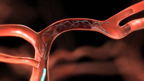 Animation eines Stents in einer Arterie
