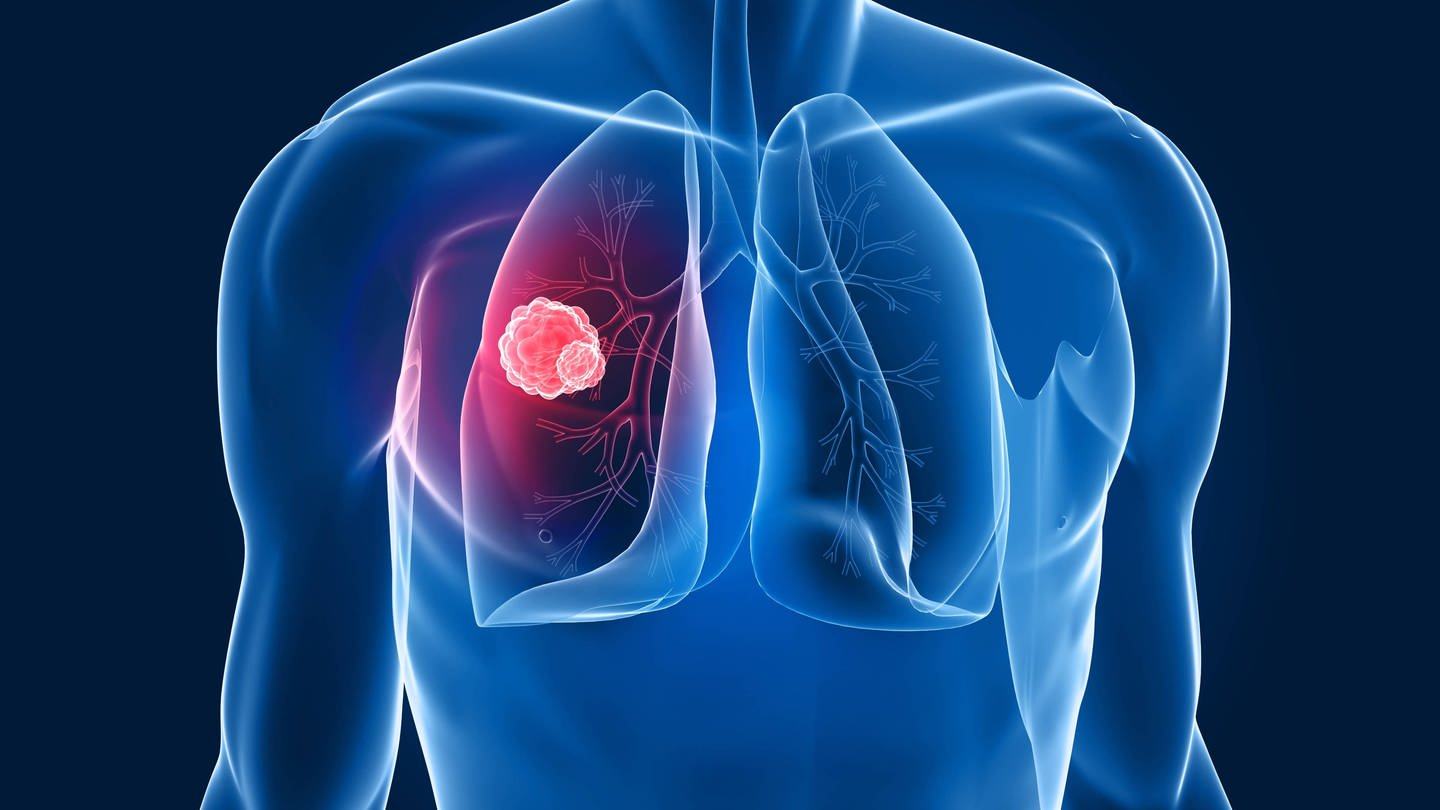 Die Illustration zeigt einen Lungentumor.