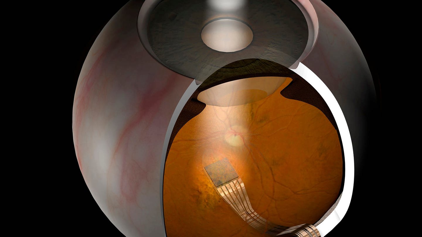 Die Grafik zeigt den Netzhaut-Chip der Firma Retina Implant im menschlichen Auge.