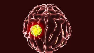 Illustration eines Gehirns mit Tumor