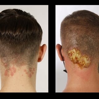 Der hochansteckende Hautpilz, der sich aktuell verstärkt über Barbershops ausbreitet, kann juckende Rötungen, aber auch Entzündungen verursachen. Er lässt sich mit Tabletten behandeln, die über Monate genommen werden müssen. 
