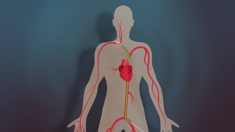 Eine Grafik von einem Körper, in dem das Blutkreislaufsystem abgebildet ist. Bei der Lazarus-OP wird ein Katheter zum verstopften Gefäß geführt. Dann kann der Verschluss gegriffen und herausgezogen oder abgesaugt werden. 