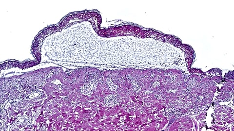 Die Aufnahme einer toxischen epidermalen Nekrolyse, die eine Ablösung der Epidermis zeigt. An der Hauterkrankung sterben etwa 30 Prozent der Betroffenen. Jetzt haben Forscher eine neue Option zur Behandlung entdeckt.