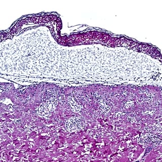 Die Aufnahme einer toxischen epidermalen Nekrolyse, die eine Ablösung der Epidermis zeigt. An der Hauterkrankung sterben etwa 30 Prozent der Betroffenen. Jetzt haben Forscher eine neue Option zur Behandlung entdeckt.