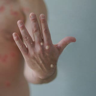 Ein typisches Symptom von Mpox sind Pusteln auf der Haut. In Deutschland ist nun der erste Fall einer Infektion mit der neuen Variante des Virus nachgewiesen worden.