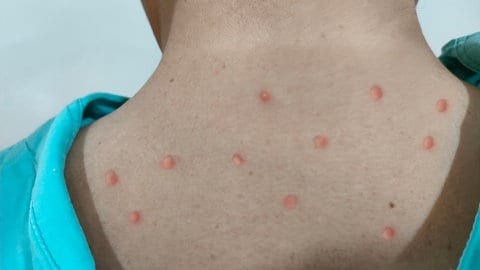 Die für das Mpox-Virus typischen Hautveränderungen entwickeln sich im Verlauf der Erkrankung von Flecken zu Pusteln. Zum Ende verkrusten diese und fallen ab.