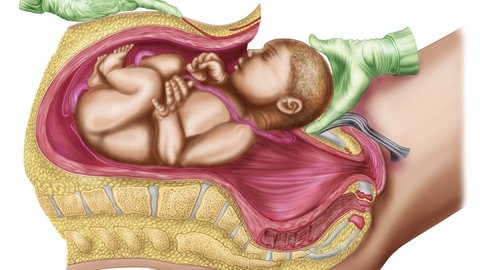 Bei einem Kaiserschnitt wird das Baby direkt aus der Gebärmutter geholt. Es kommt dabei nicht mit den Bakterien im Geburtskanal der Mutter in Kontakt.