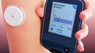 Kontinuierliche Messung des Blutzuckers auch CGM-System genannt. Mit einem Sensor unter der Haut wird kontinuierlich der Blutzucker von Menschen mit Diabetes gemessen. 