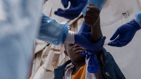 Ein mit Mpox infizierter Junge aus dem Kongo wird behandelt. Für Kinder ist das Virus lebensgefährlich. tags: Mpox Mpox-Virus Schulschließung